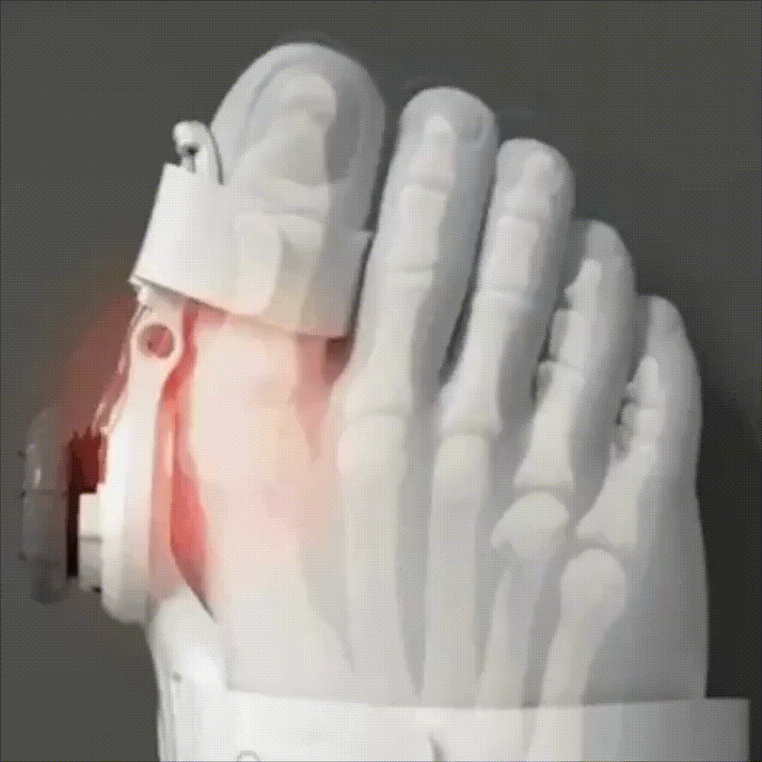 Caezor Bunion Fix mechanism in motion
